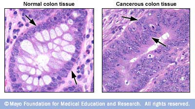 What cancer looks like