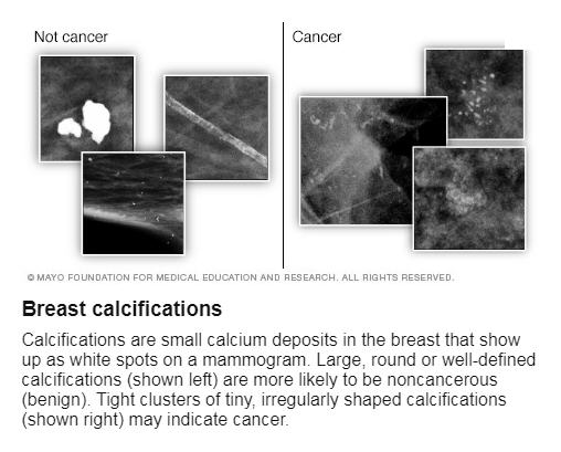 Mammogram