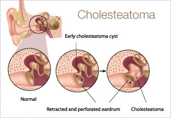 P_Breidung_Cholesteatoma