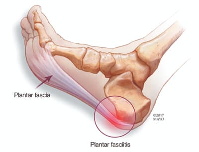 plantar faciitis image