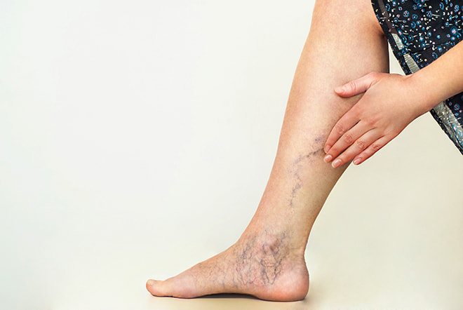 Woman touching varicose veins on leg