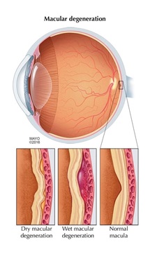 Macular degeneration illustration