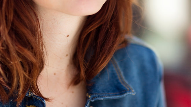 Moles on neck closeup