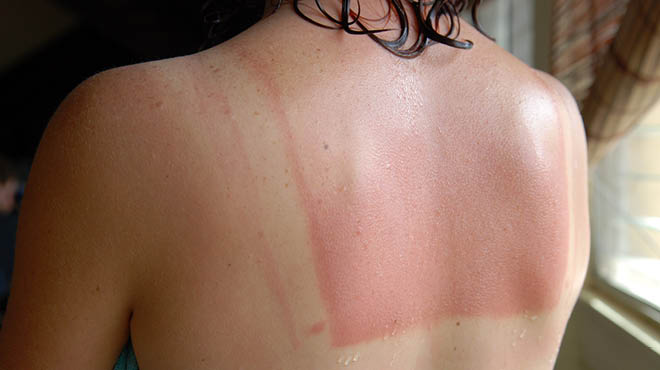 Sunburned back