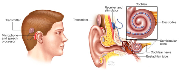 Cochlear implant illustration