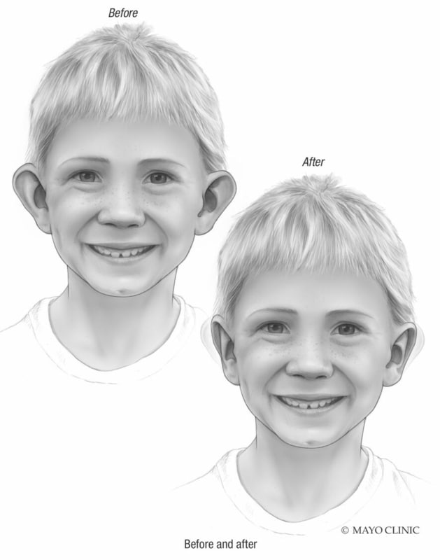 Ears Assymetry Feeling like you're all ears? - Mayo Clinic Health System
