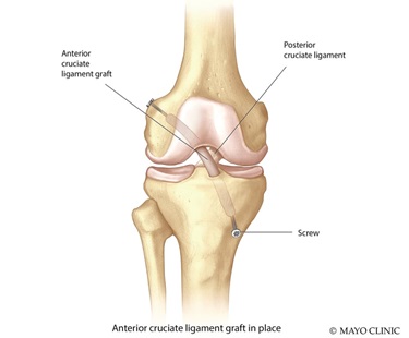 ACL graft illustration