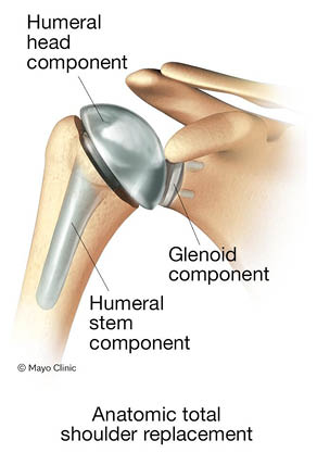 Illustration of Shoulder Replacement Options