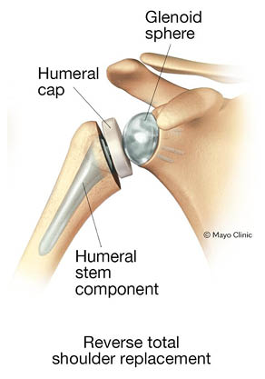 Illustration of Shoulder Replacement Options