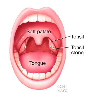 Tonsil stone illustration