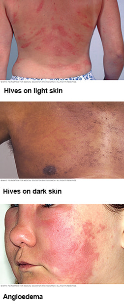 Hives