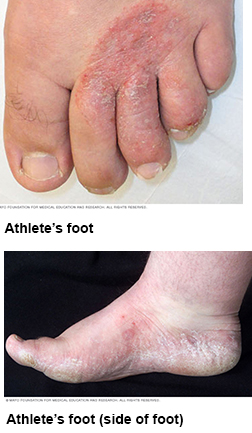 Athlete's Foot