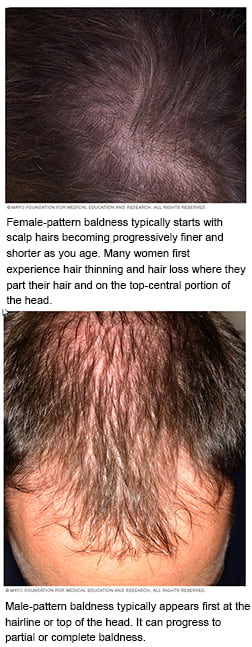 Hair Loss
