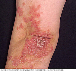 Psoriasis