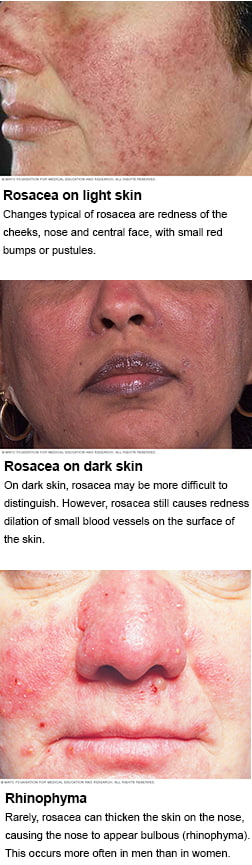 Rosacea
