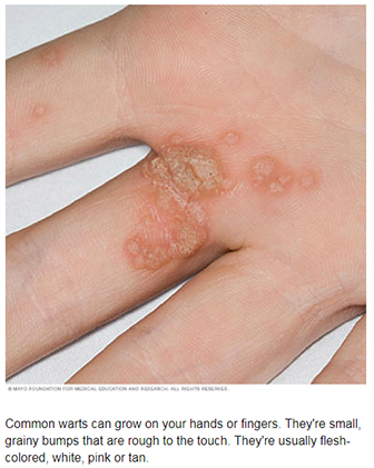 Warts
