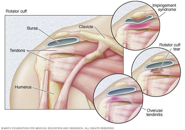 Rotator Cuff Injury