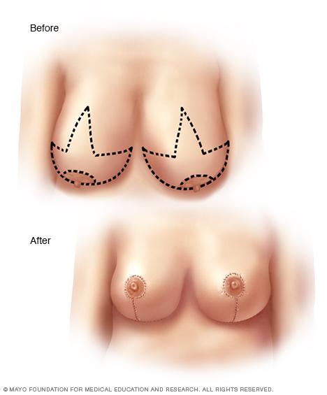 Breast Reduction