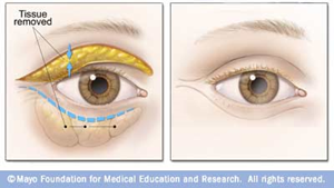 Eyelid surgery