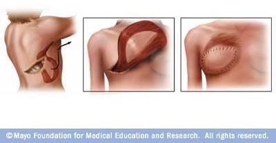 Latissimus Dorsi Flap