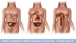 Pedicle Tram Flap