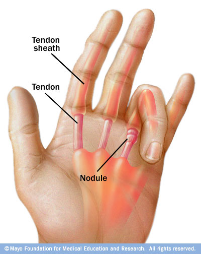 Trigger Finger