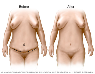 Tummy Tuck
