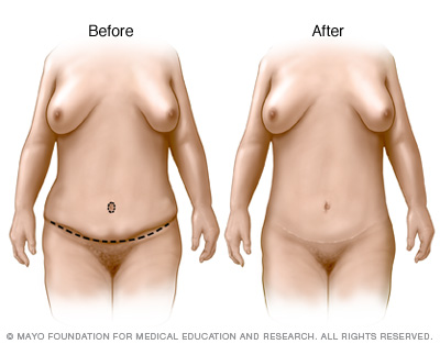 Tummy Tuck