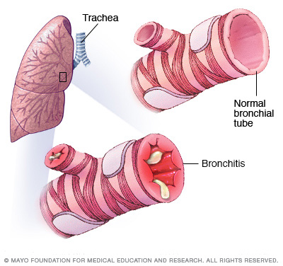 Bronchitis