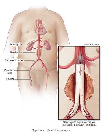 Abdominal Aortic Aneurysm Repair