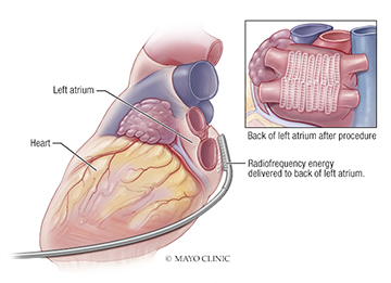 Illustration of hybrid ablation