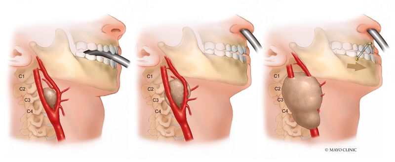 Illustration of Carotid Body Tumor