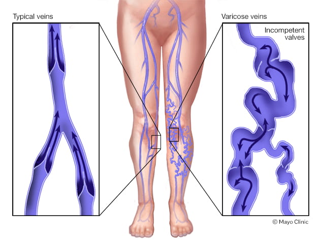 Illustration of Varicose Veins