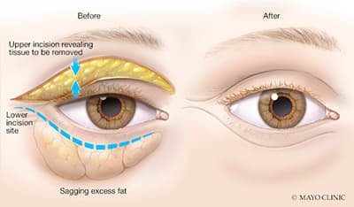 Blepharoplasty