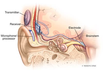 Hearing Loss Diagram