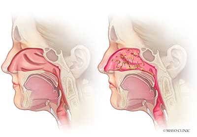 Rhinitis