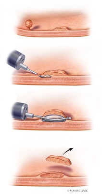 Endoscopic mucosal resection