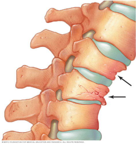 CompressionFracture