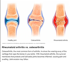 Arthritis
