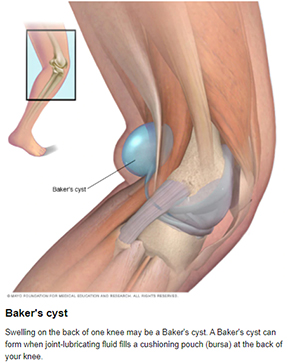 Bakers Cyst