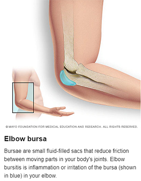 Elbow Bursitis
