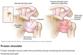 Frozen Shoulder