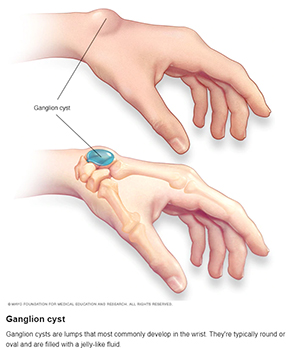 Ganglion Cyst