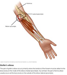 Golfers Elbow
