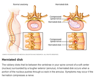 Herniated Disk