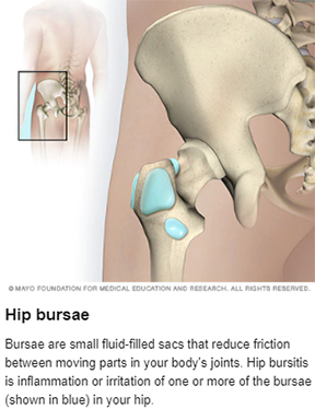 Hip Bursitis