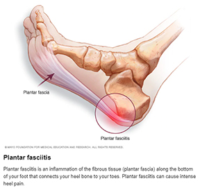 Plantar Fascitis