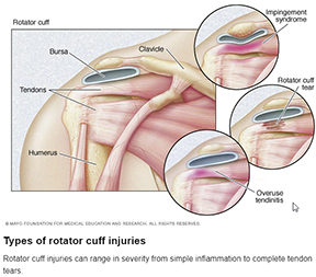 Rotator Cuff Injury