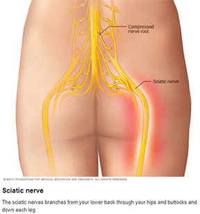 Sciatic Nerve Pain