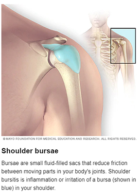Shoulder Bursitis